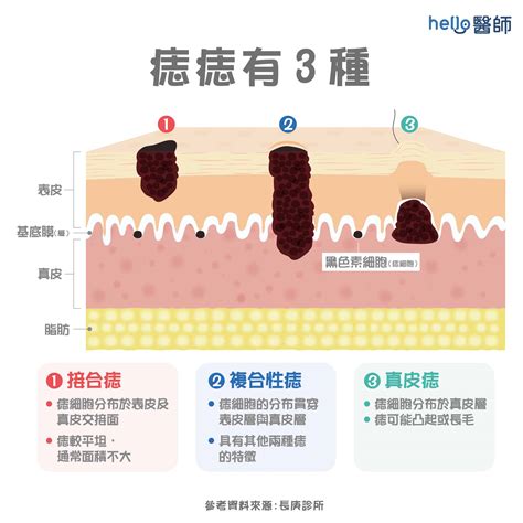 手臂長很多痣|痣形成的原因？痣長毛、痣變多變大是痣病變？5招判。